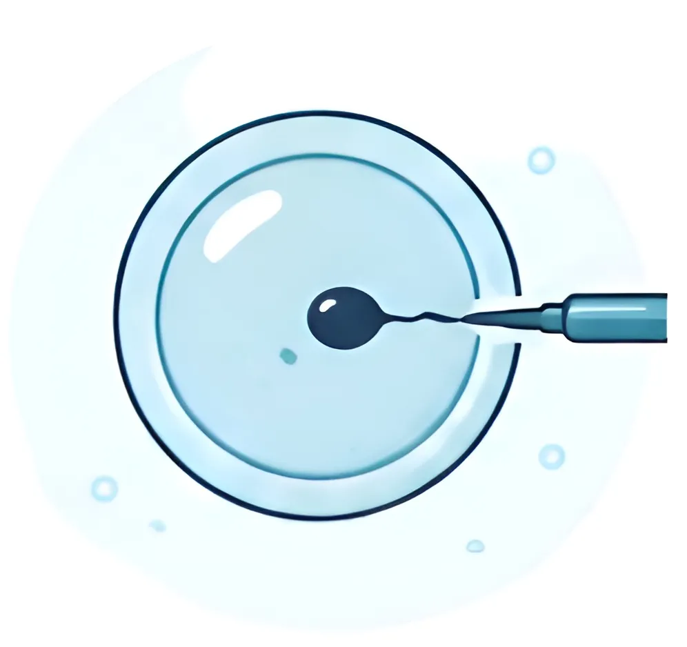 Intracytoplasmic Sperm Injection (ICSI)